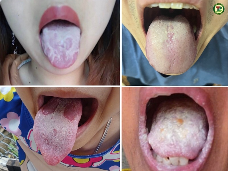 Nấm Lưỡi Trắng: Nguyên Nhân Và Cach Điều Trị Hiệu Quả